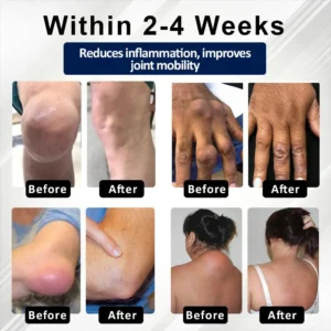 Glowrizon™ BeeEase MicroSting Joint Patches
