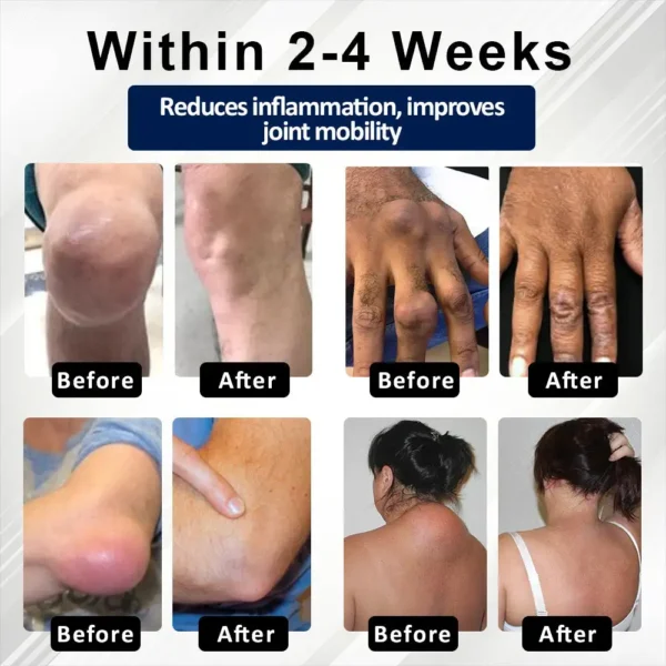 Glowrizon™ BeeEase MicroSting Joint Patches