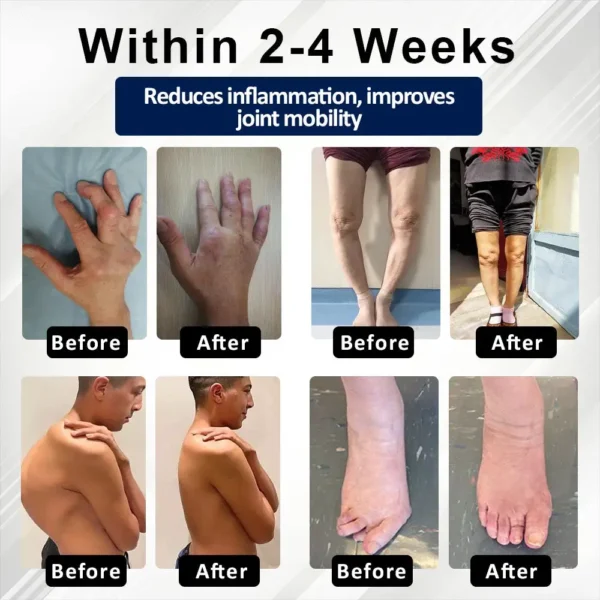 Glowrizon™ BeeEase MicroSting Joint Patches