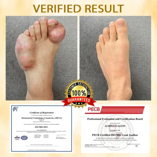 Glowrizon™ BeeEase MicroSting Joint Patches
