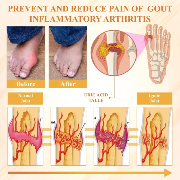 Glowrizon™ BeeEase MicroSting Joint Patches